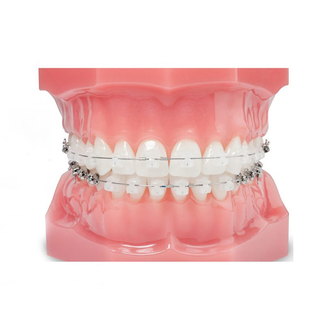 Implantes Dentales en Querétaro
