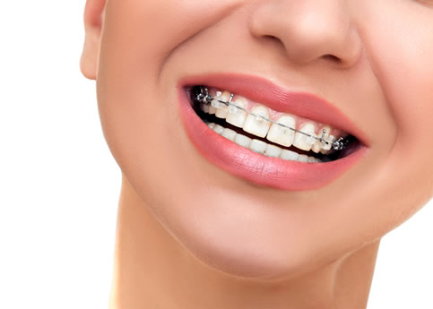 Brackets en Querétaro